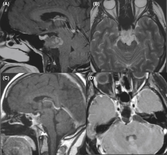 Recurrent Skull Base Chordomas: Role Of Surgery | Neupsy Key