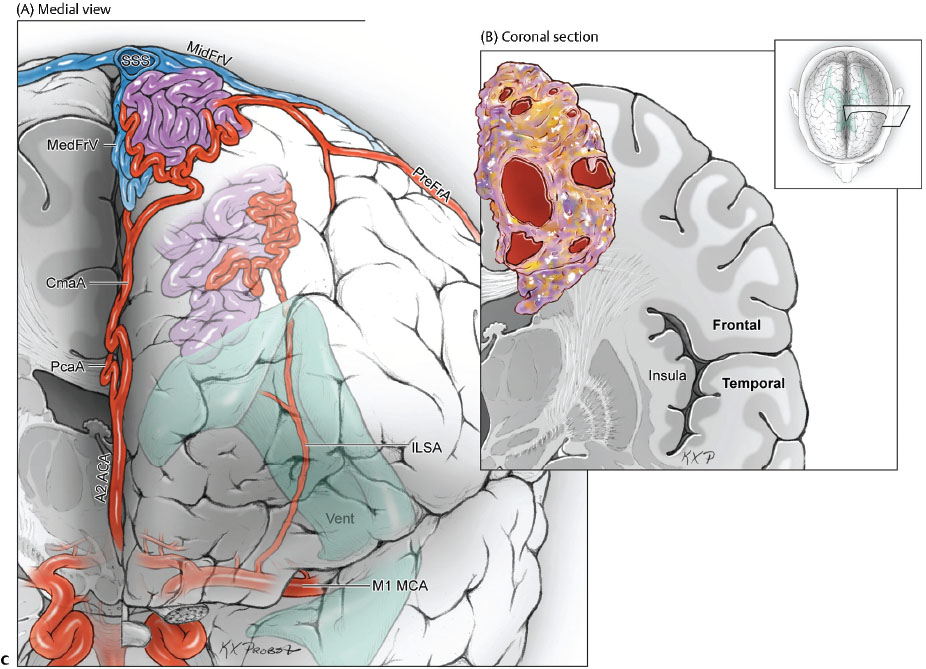 Cerebrovascular Anatomy And Implications For Arteriovenous Malformation ...