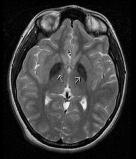 Movement Disorders | Neupsy Key