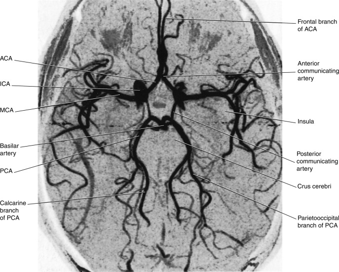 Cerebrovascular Disease | Neupsy Key