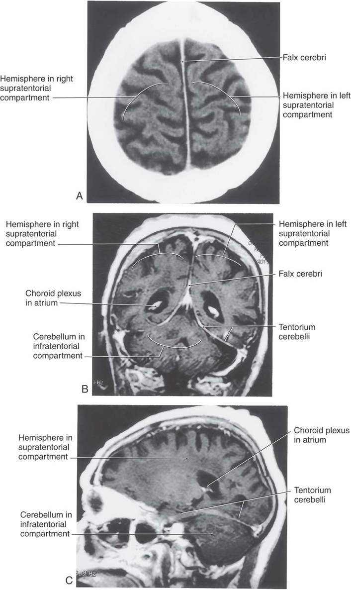 The Meninges | Neupsy Key