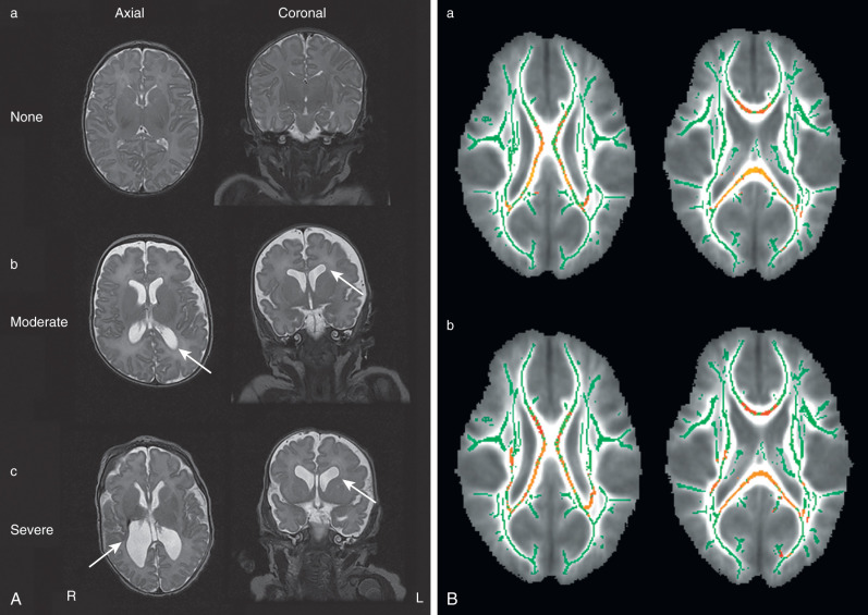 Myelination Events | Neupsy Key