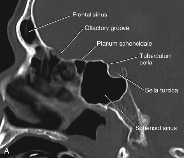 Midline Anterior Skull Base Meningiomas | Neupsy Key