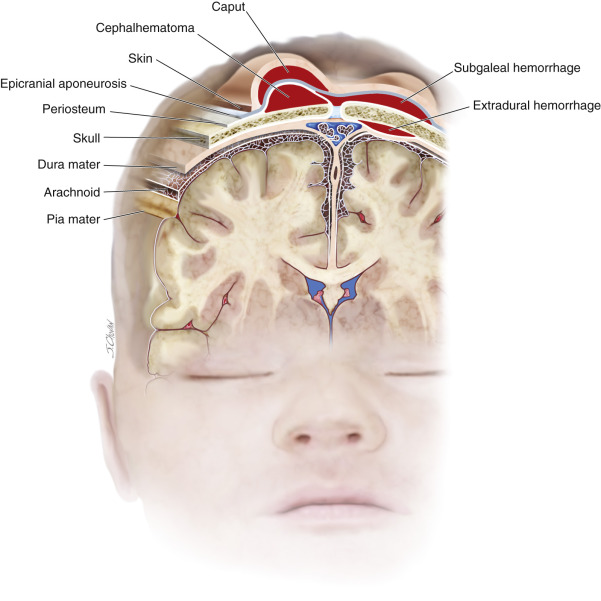 Injuries Of Extracranial, Cranial, Intracranial, Spinal Cord, And ...