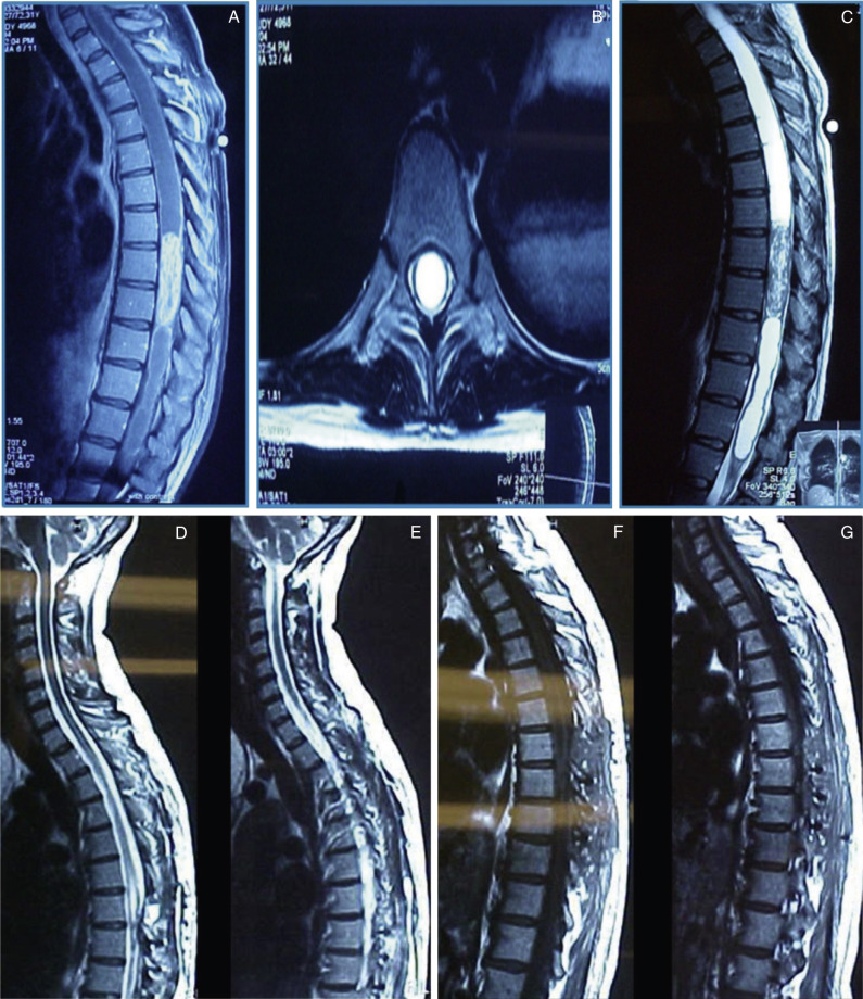 Complications Of Surgery For Intrinsic Spinal Cord Tumors | Neupsy Key