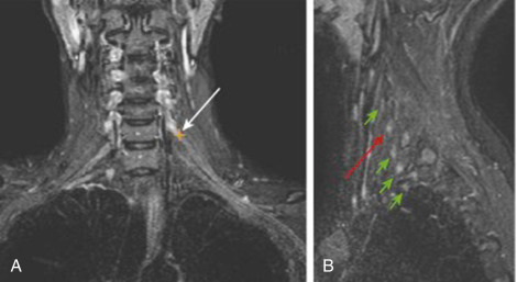 Thoracic Outlet Syndrome | Neupsy Key