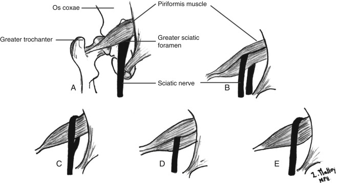 Piriformis Syndrome: A Review Of The Evidence And Proposed New Criteria ...