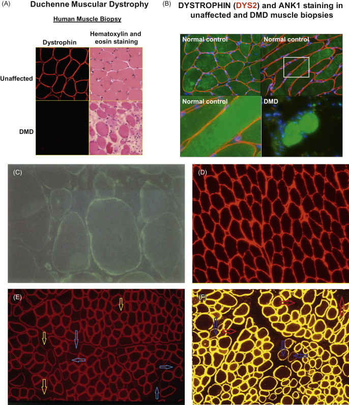 Dystrophinopathies | Neupsy Key