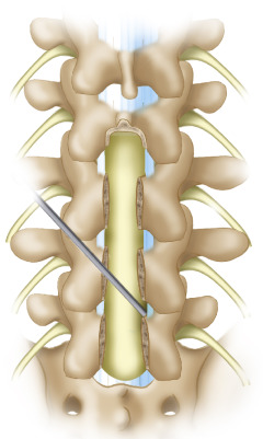 Lumbar Laminectomy | Neupsy Key