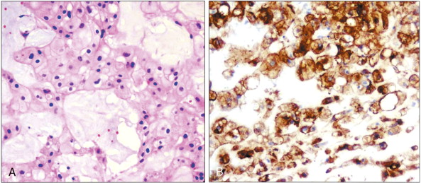 Classification, Pathobiology, Molecular Markers, And Intraoperative ...