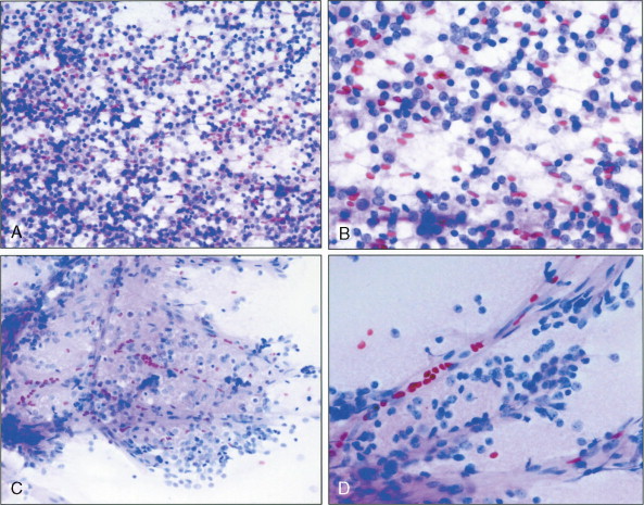 Classification, Pathobiology, Molecular Markers, And Intraoperative ...