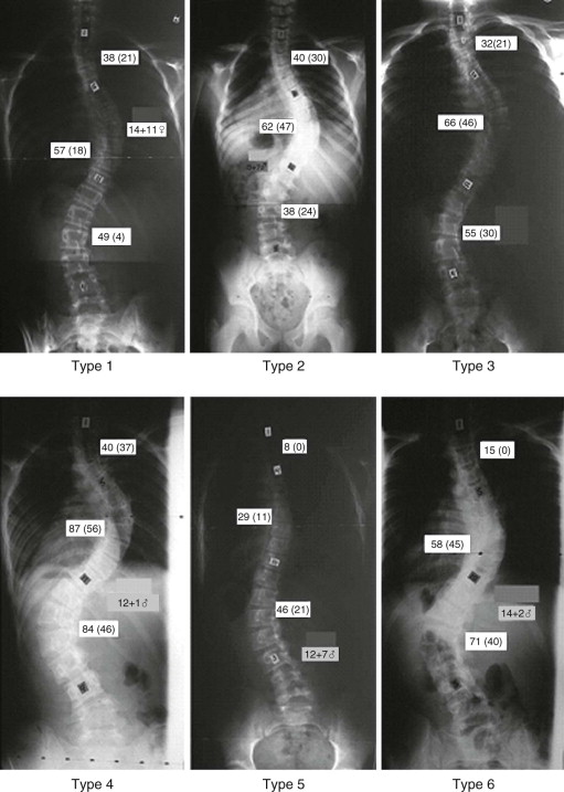 Surgical Treatment Of Adolescent Idiopathic Scoliosis: Lenke Curve ...