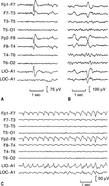 Electroencephalography: General Principles And Clinical Applications ...