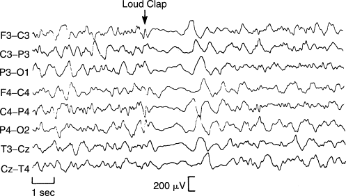 Electroencephalography: General Principles And Clinical Applications ...