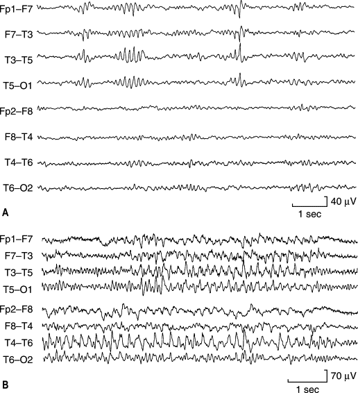 Electroencephalographic Artifacts And Benign Variants | Neupsy Key