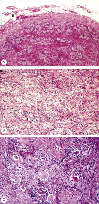 Paraneoplastic Syndromes Involving The Nervous System | Neupsy Key