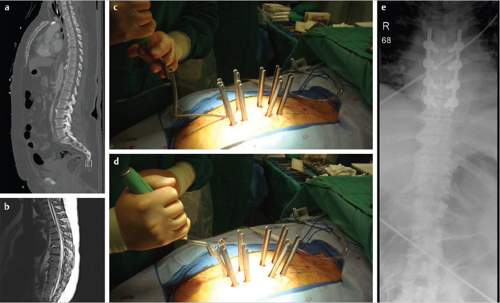 Minimally Invasive Spine Surgery: Thoracic Case Studies | Neupsy Key