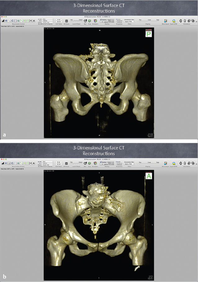 Stabilization Of The Sacroiliac Joint With The Sacroiliac Bone Surgical ...