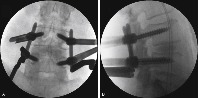 Endoscopic Lumbar Interbody Fusion Neupsy Key