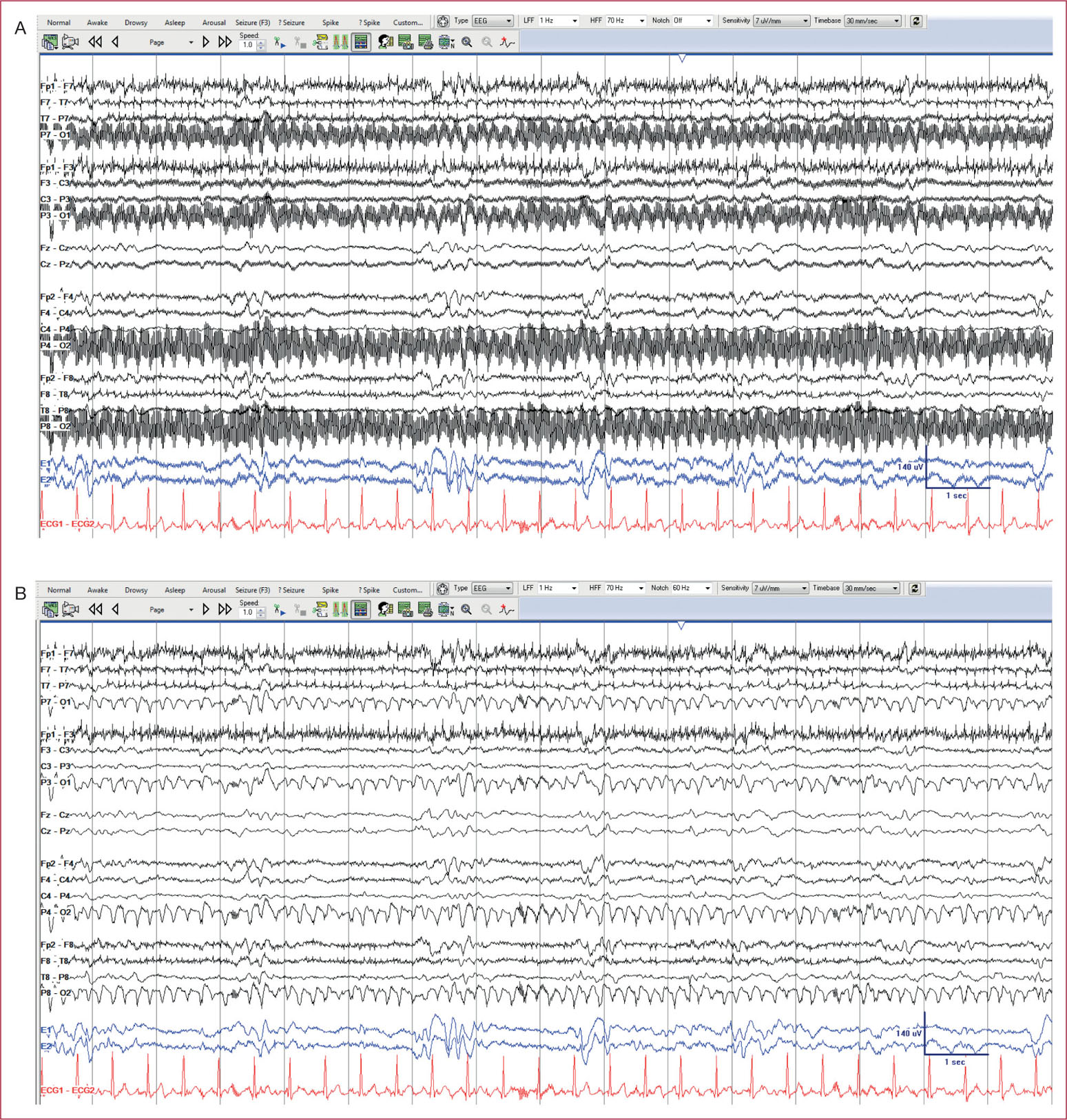 Electroencephalography and Artifact in the Intensive Care Unit | Neupsy Key