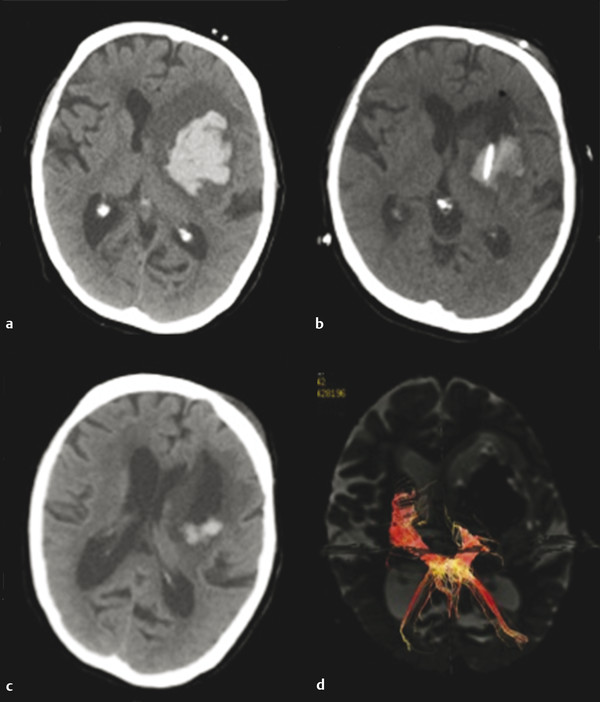 Minimally Invasive Approaches For Spontaneous Intracerebral Hemorrhage ...