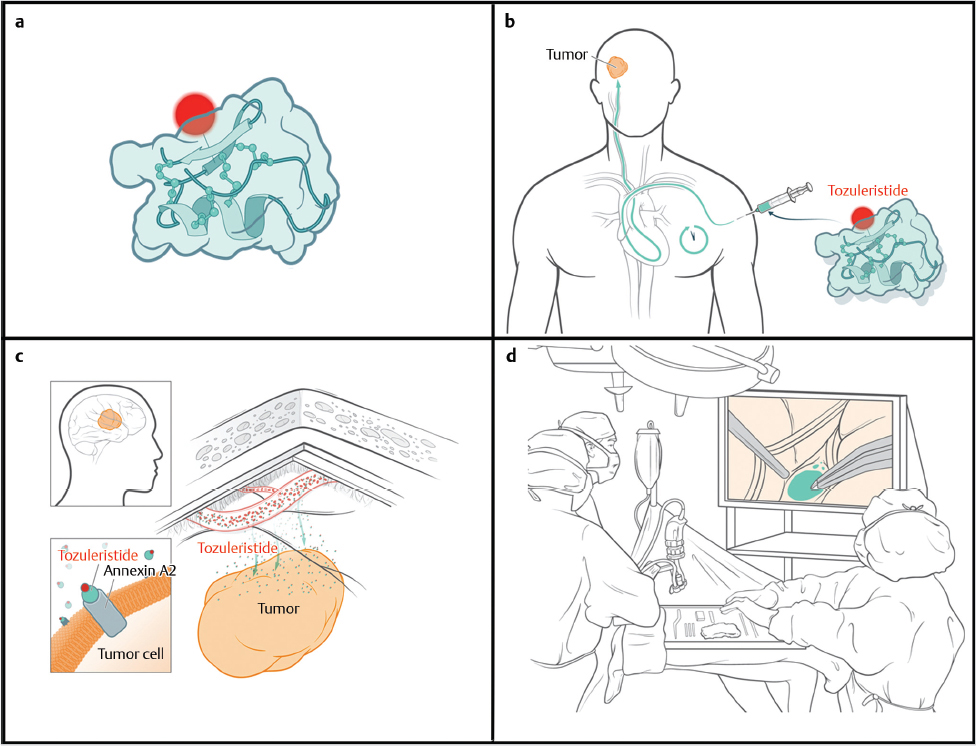 Tozuleristide Fluorescence-Guided Surgery Of Brain Tumors | Neupsy Key