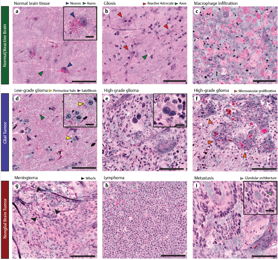 Raman Spectroscopy And Brain Tumors | Neupsy Key