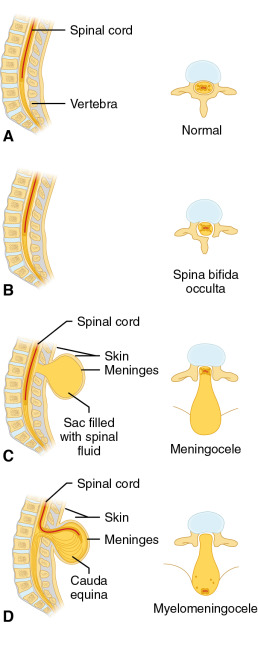 Spina Bifida: A Neural Tube Defect | Neupsy Key