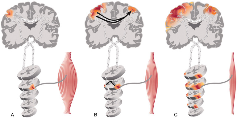 Neuromuscular Diseases | Neupsy Key