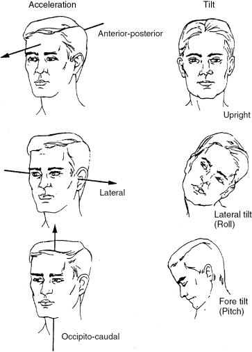 Vestibular Dysfunction | Neupsy Key