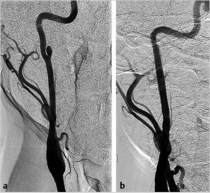 12 Traumatic And Iatrogenic Carotid Artery Injury | Neupsy Key