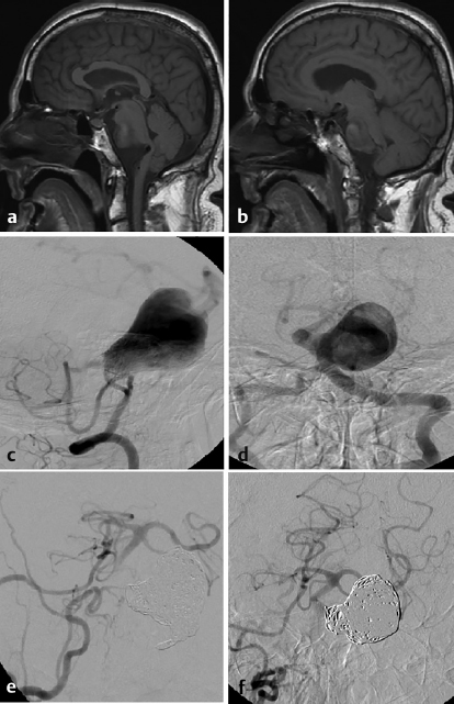 42 Anterior Inferior Cerebellar Artery Aneurysms | Neupsy Key