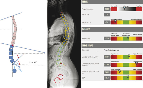 6 Spinal Curves Segmentation And Lumbar Lordosis Classification ...