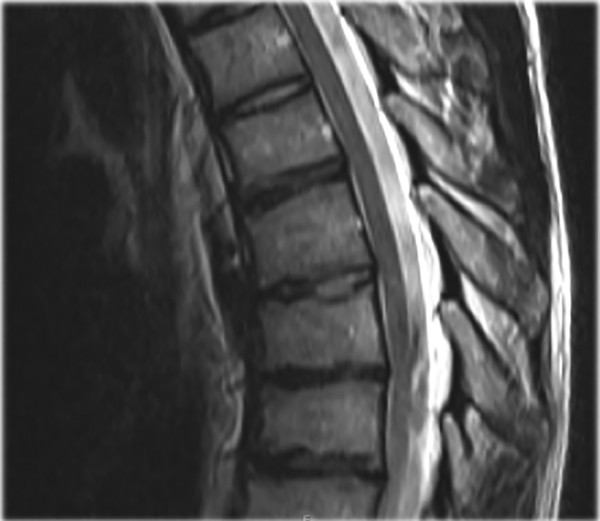 15 Scheuermann’s Kyphosis | Neupsy Key