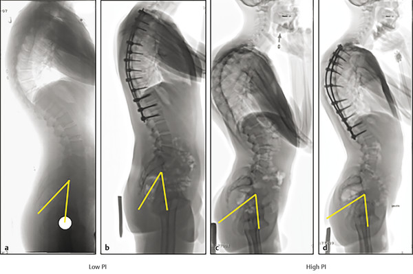 15 Scheuermann’s Kyphosis | Neupsy Key