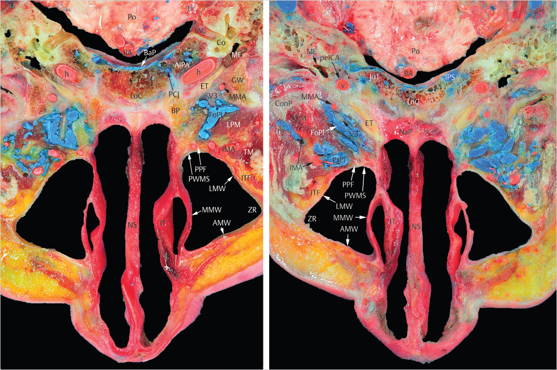 1 Classification Of Endoscopic Transnasal Approaches To The Skull Base ...