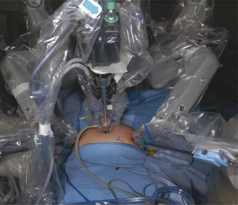 27 Robotic Anterior Lumbar Interbody Fusion Neupsy Key