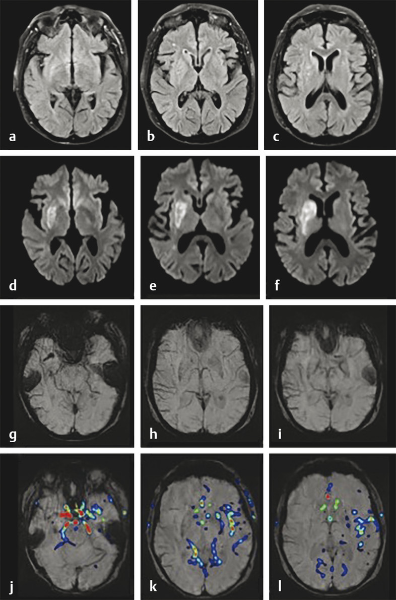 4 Imaging Techniques In Acute Ischemic Stroke | Neupsy Key