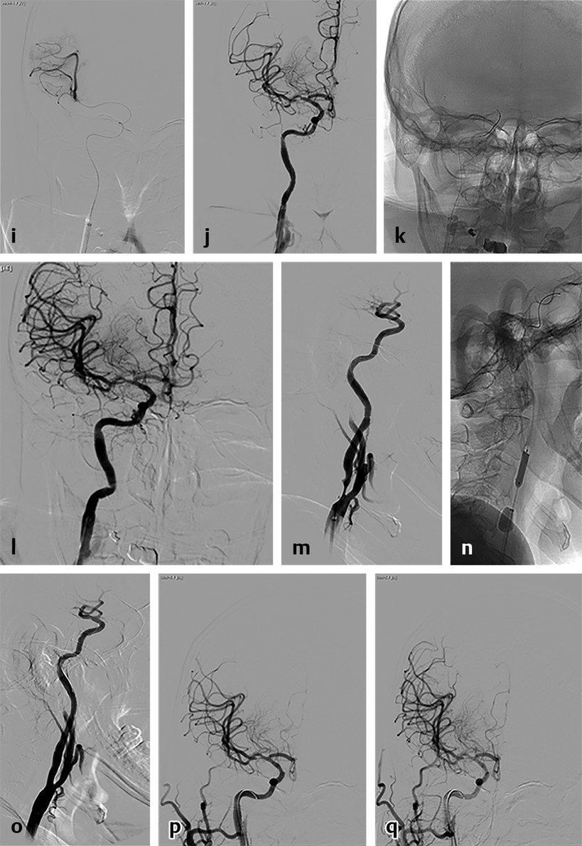 7 Mechanical Thrombectomy With Retrievable Stents | Neupsy Key