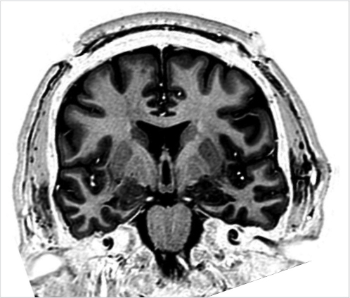 4 MRI And CT Imaging With Stereotactic Neurosurgery | Neupsy Key