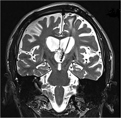 15 Surgical Treatment Of Dystonia | Neupsy Key