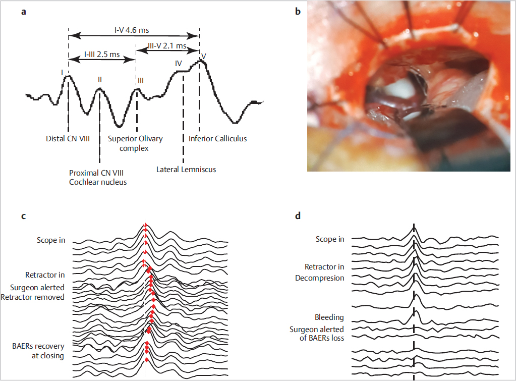 38 Intraoperative Neurophysiologic Monitoring During Microvascular ...