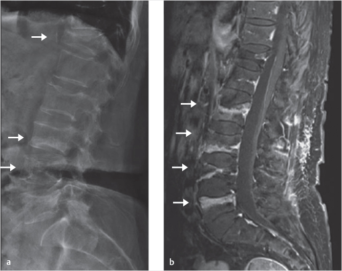 23 Number Of Levels Appropriately Treated With Vertebral Augmentation ...