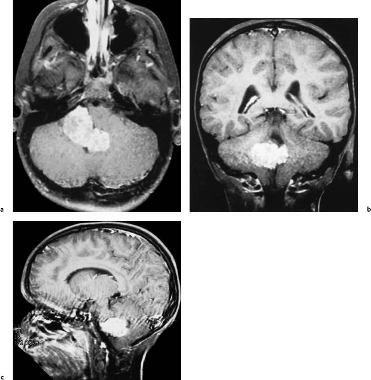 Choroid Plexus Tumors | Neupsy Key