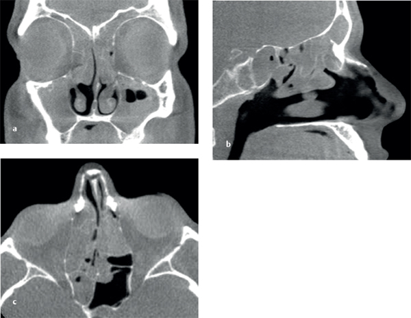 Sinonasal Olfactory Disorders | Neupsy Key