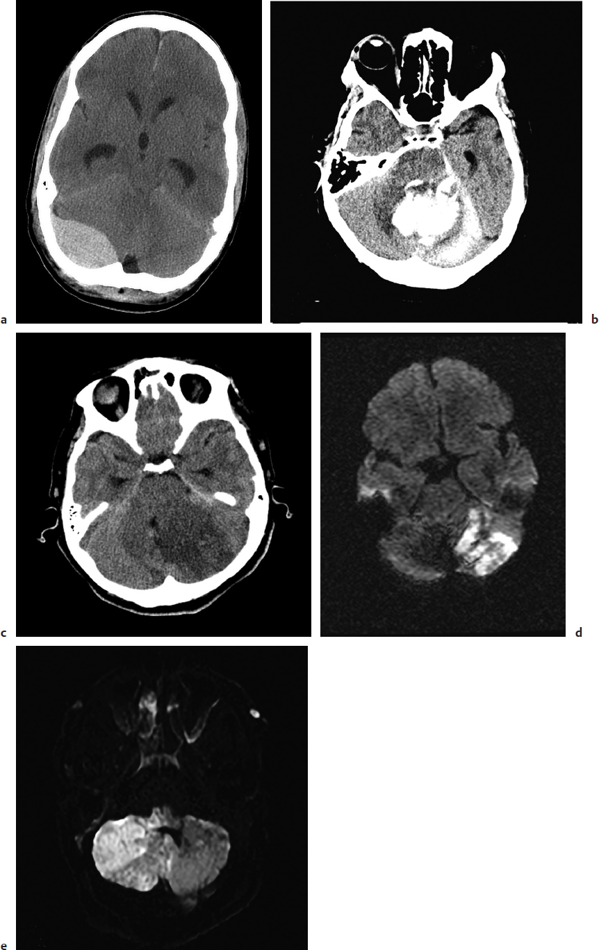 5 Surgery For Cerebellar Stroke And Suboccipital Trauma | Neupsy Key