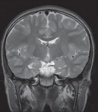 14 Hypothalamic Hamartomas Neupsy Key