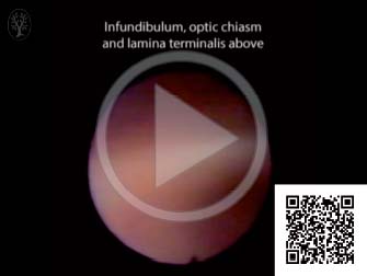 16 Intraventricular Hemorrhage | Neupsy Key