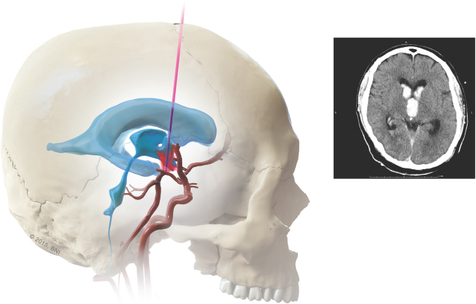 37 Complications In Neuroendoscopy | Neupsy Key