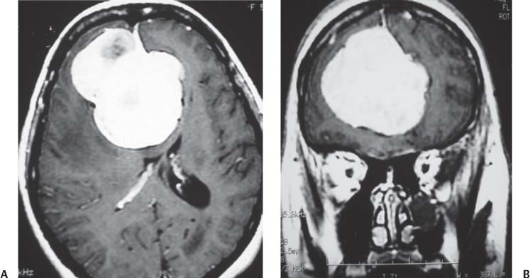 17 Falx Meningiomas | Neupsy Key